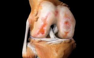 Τι είναι η οστεοαρθρίτιδα του γόνατος