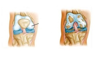 παθολογικές αλλαγές στην οστεοαρθρίτιδα του γόνατος