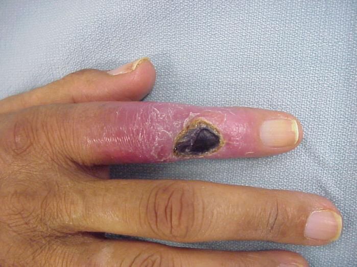 Η οστεομυελίτιδα ως αιτία πόνου στις αρθρώσεις των δακτύλων