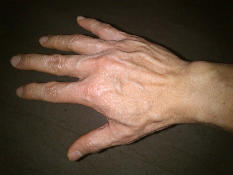 Παραμόρφωση οστών και πόνος στις αρθρώσεις των δακτύλων