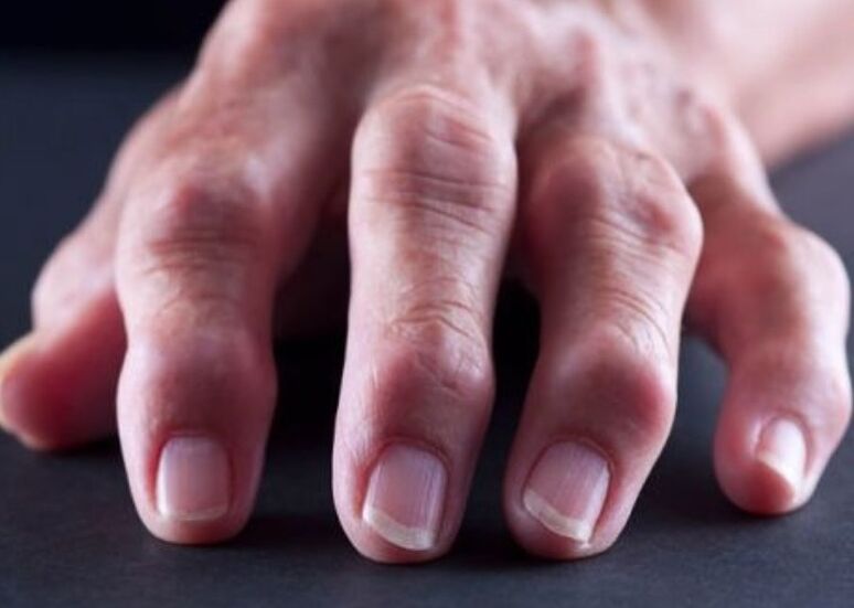 η ρευματοειδής αρθρίτιδα ως αιτία πόνου στις αρθρώσεις των δακτύλων